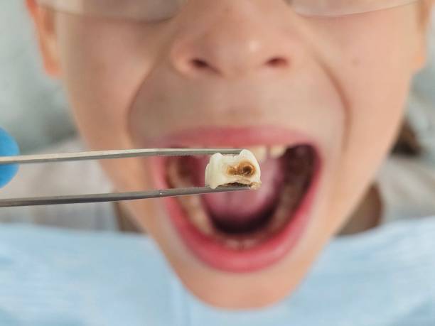 Best Emergency Treatment for Dental Infections or Abscesses in Setauket, NY