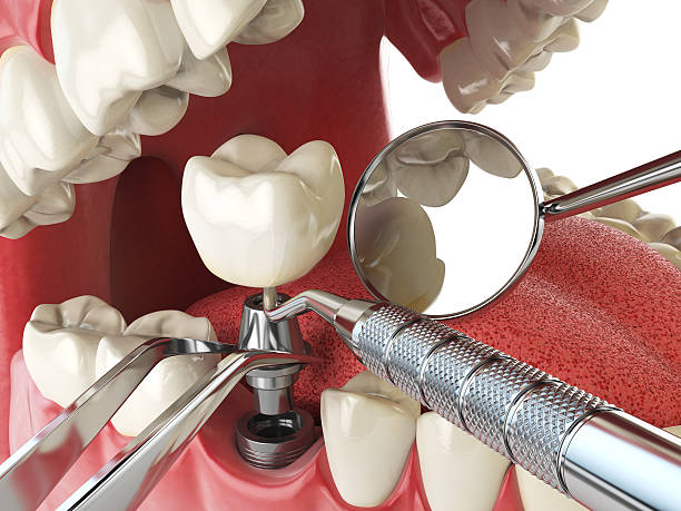Best Emergency Denture Repair in Setauket, NY